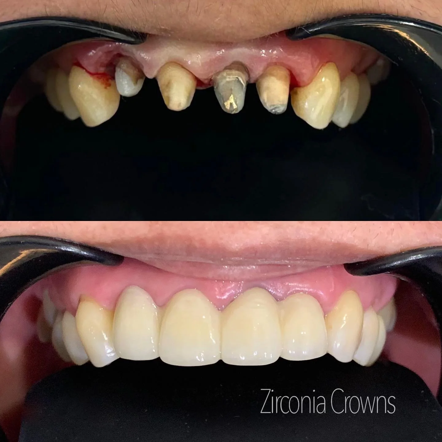 crown_zirconia4.jpg