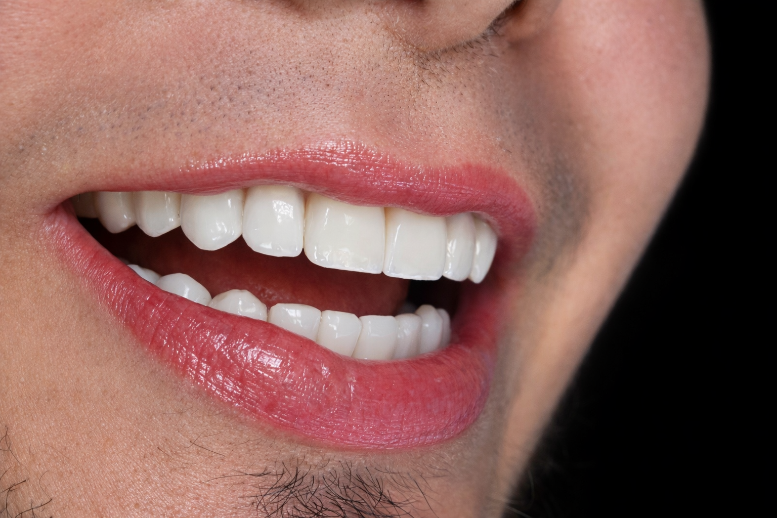 porcelain veneers in colombia