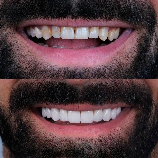 Before and after smile transformation showing yellow, misaligned teeth improved with ceramic veneers in BL1 shade for a bright, natural-looking result.