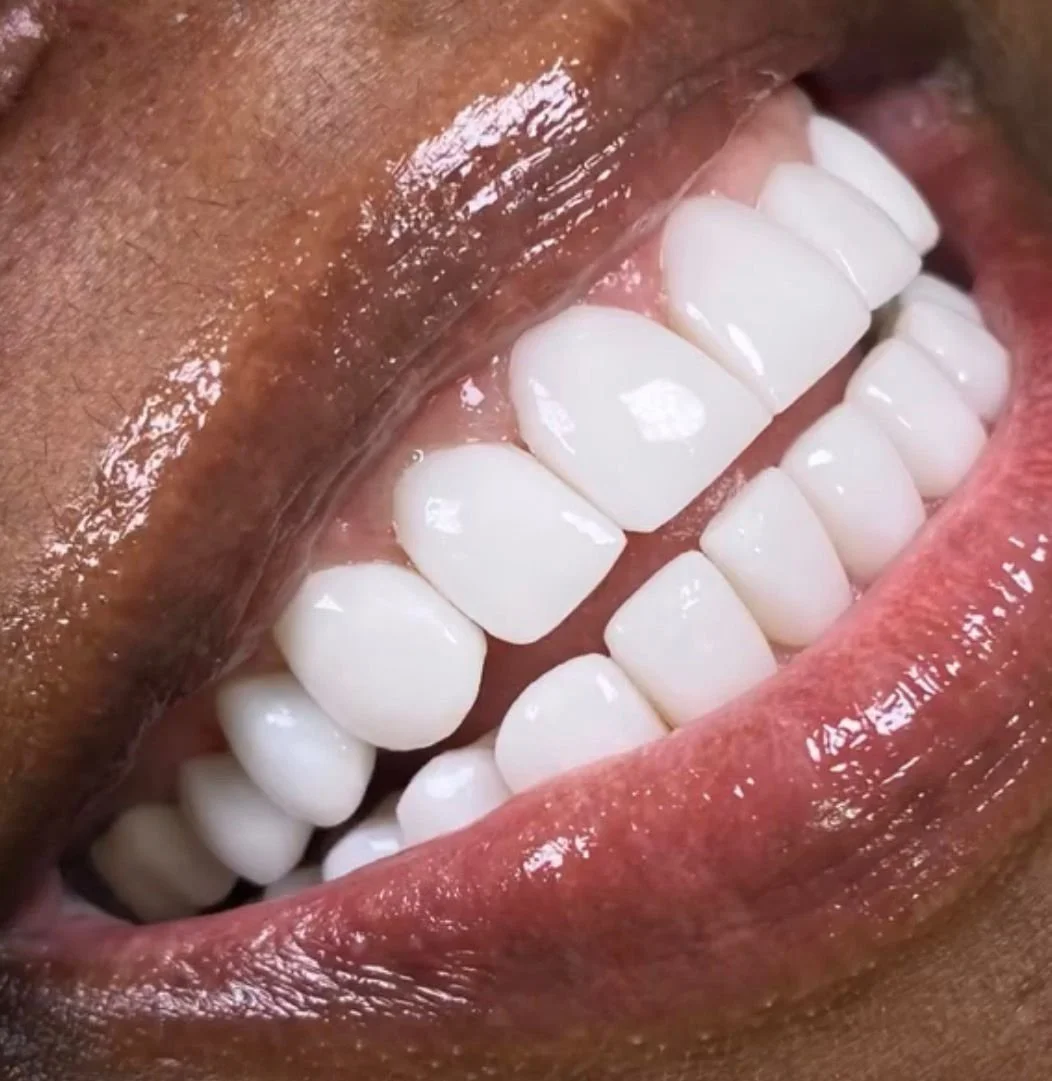 How Much Do Veneers Cost in Colombia vs the USA?