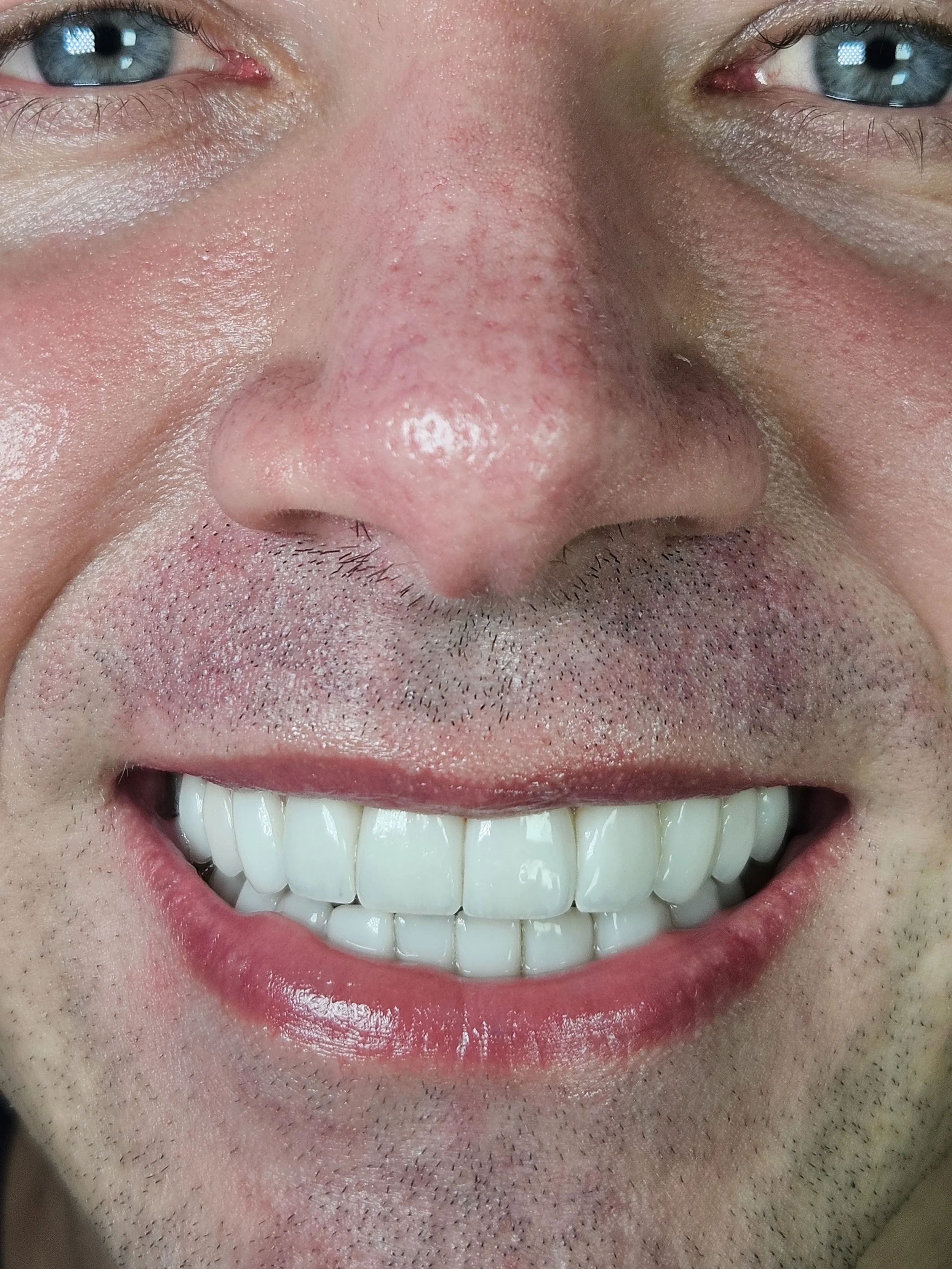 Is It Safe to Get Veneers in Bogotá, Colombia?