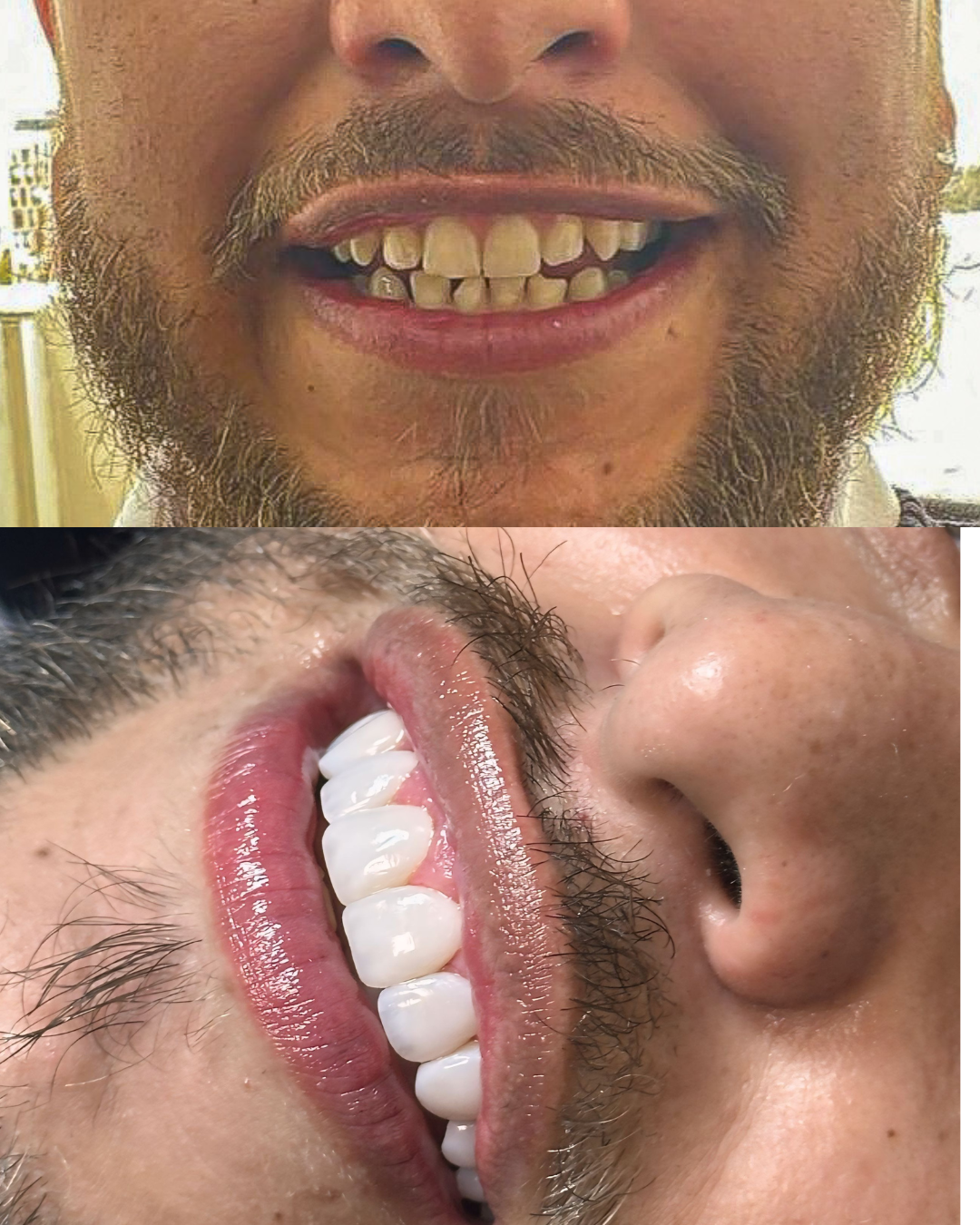 El mejor diseño de sonrisa en Bogotá, Diseño de sonrisa resina 3D