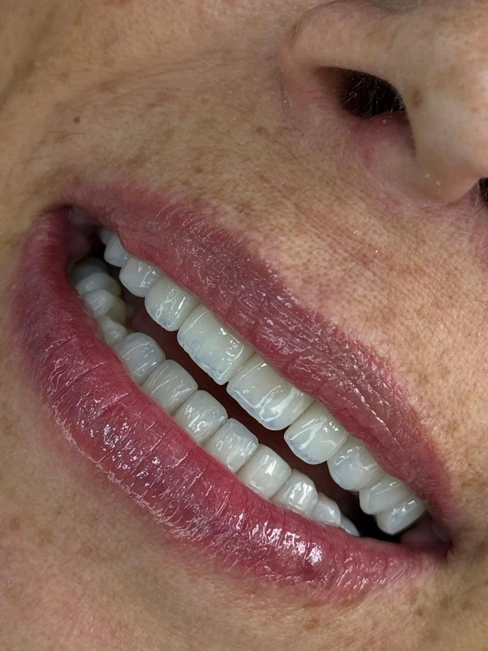 Translucent EMAX Smile