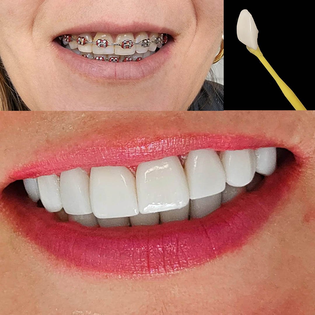 porcelain veneers bl1.jpg