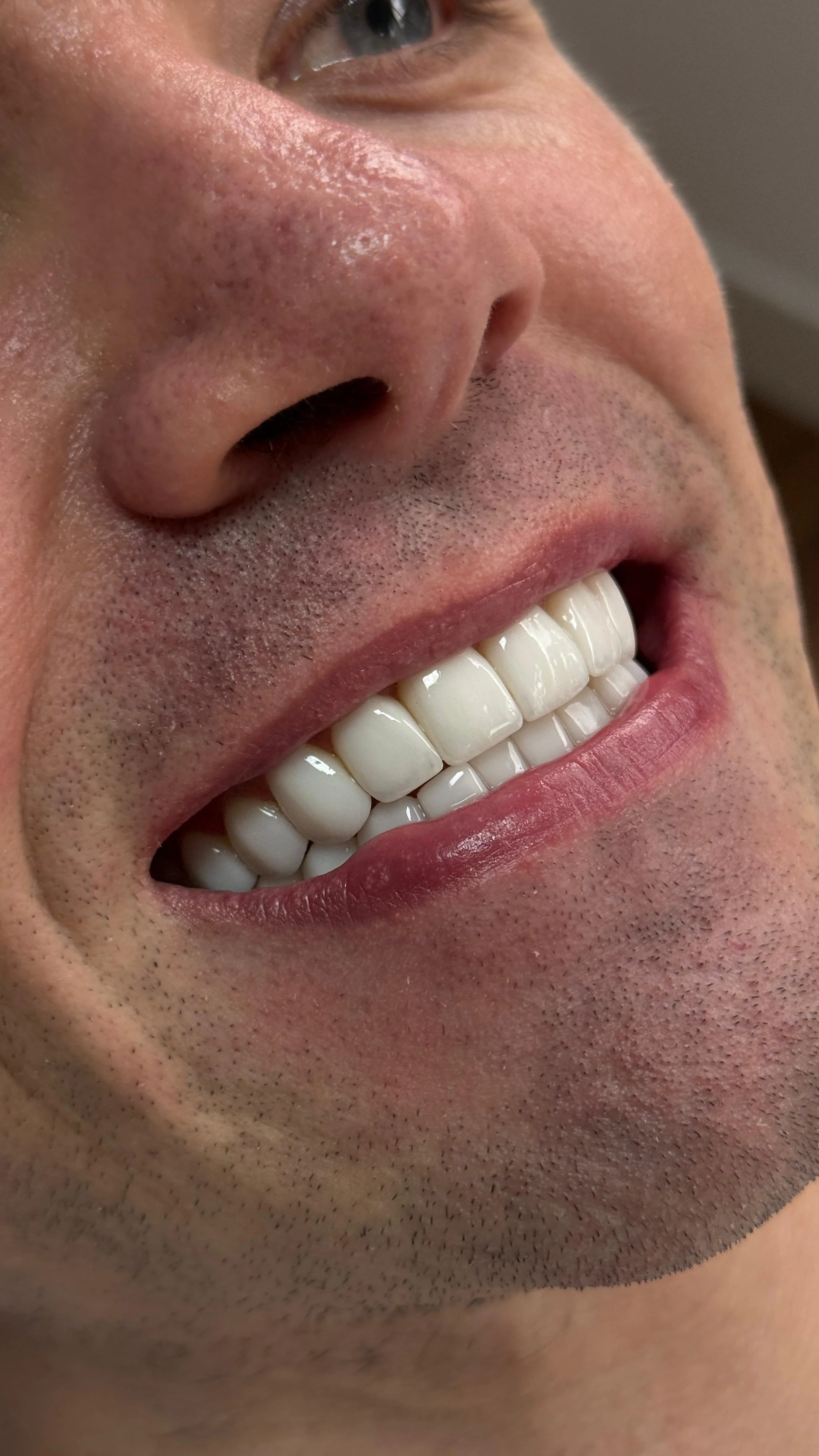 bl2 porcelain veneers