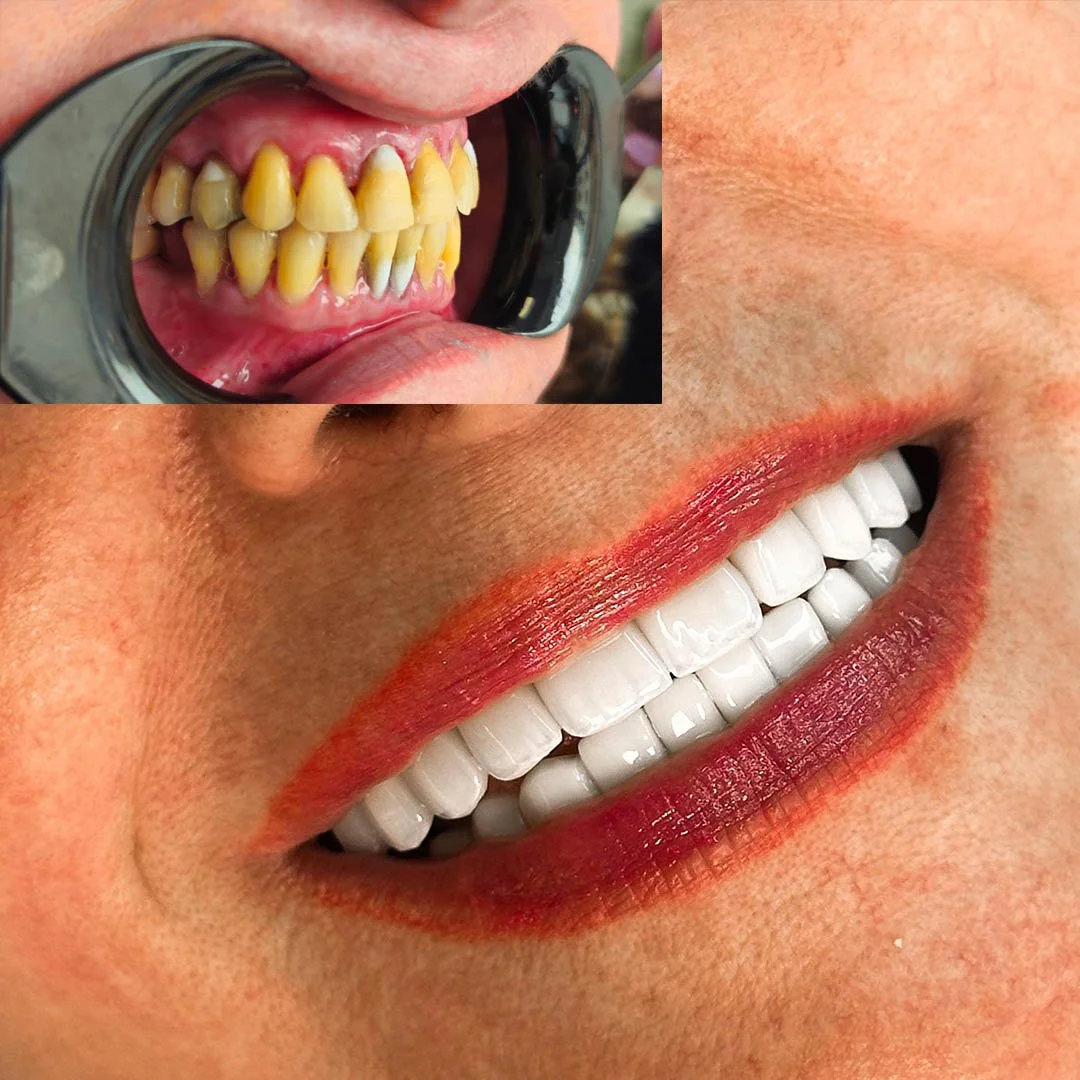 veneers BL0.jpg