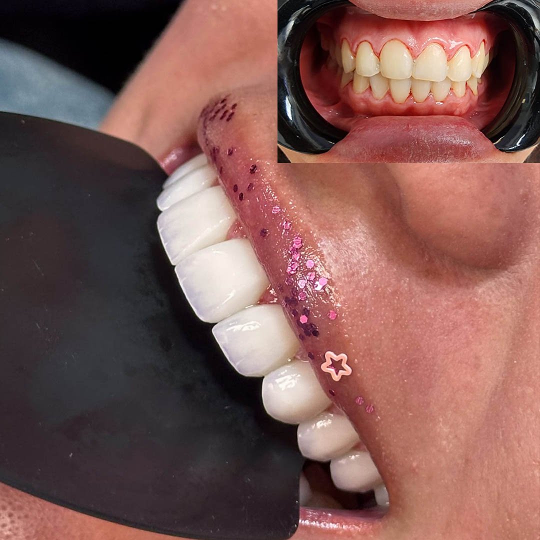 porcelain veneers bl3.jpg