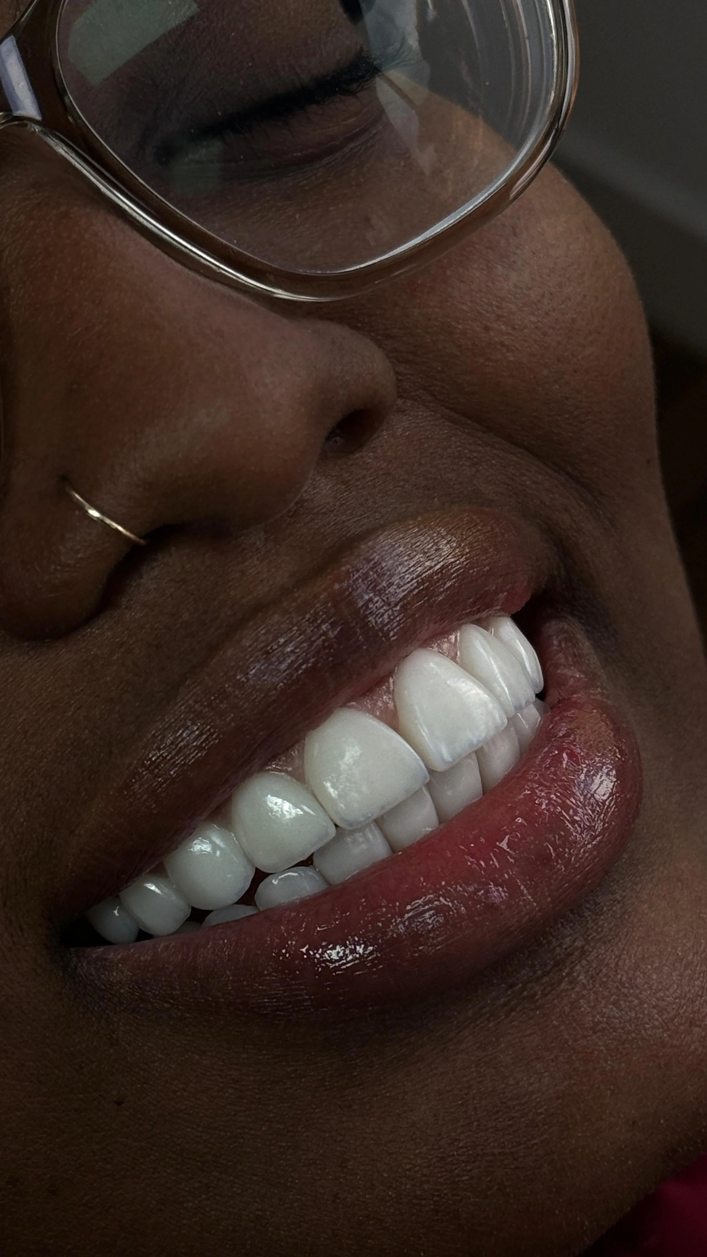 veneers, full mouth 