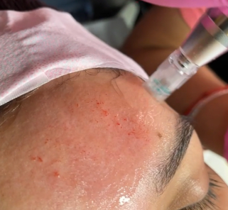 Microneedling Image.png