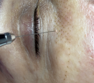 Fibroblast Image.png