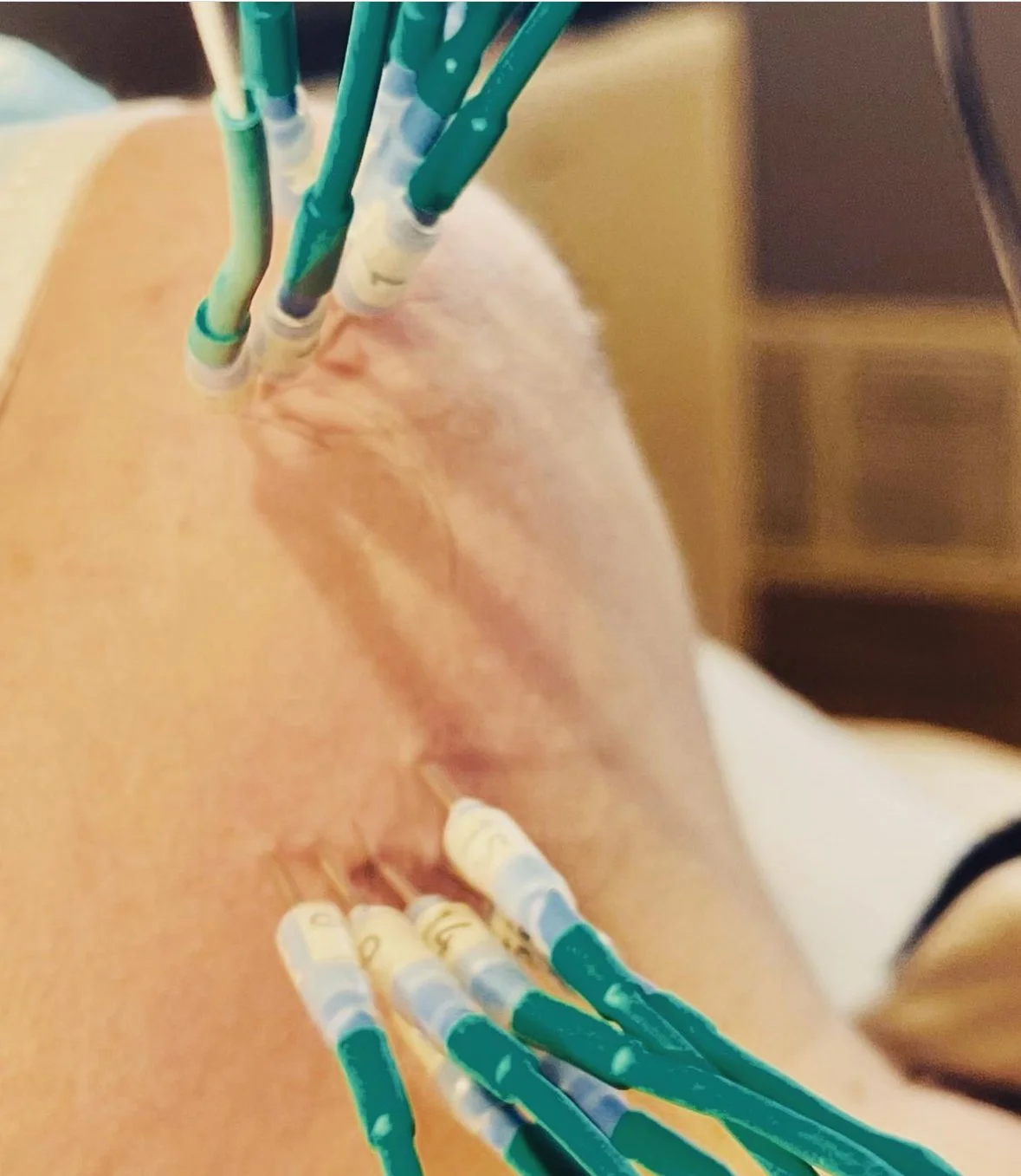 During first treatment