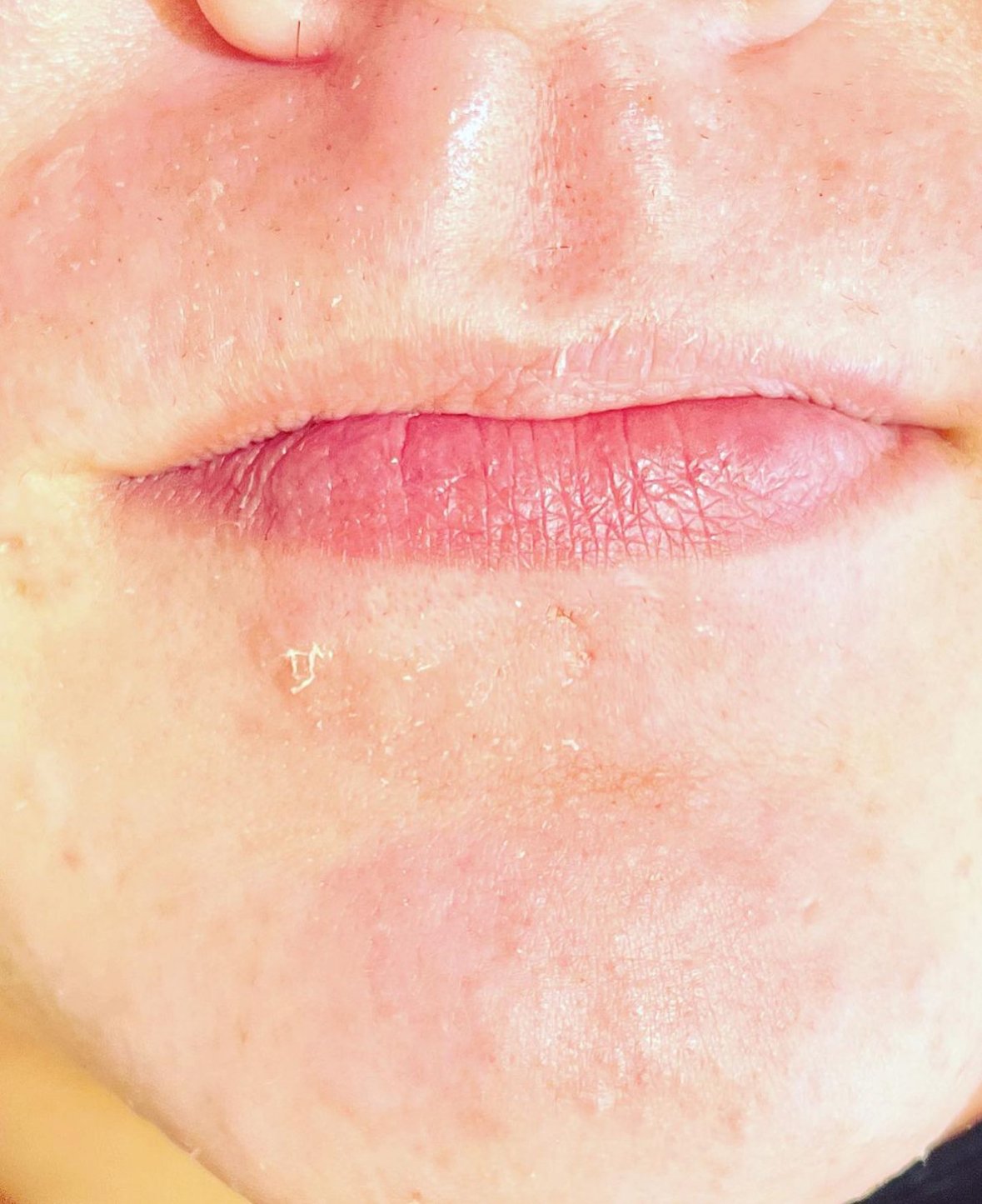 After 3 hours of treatment