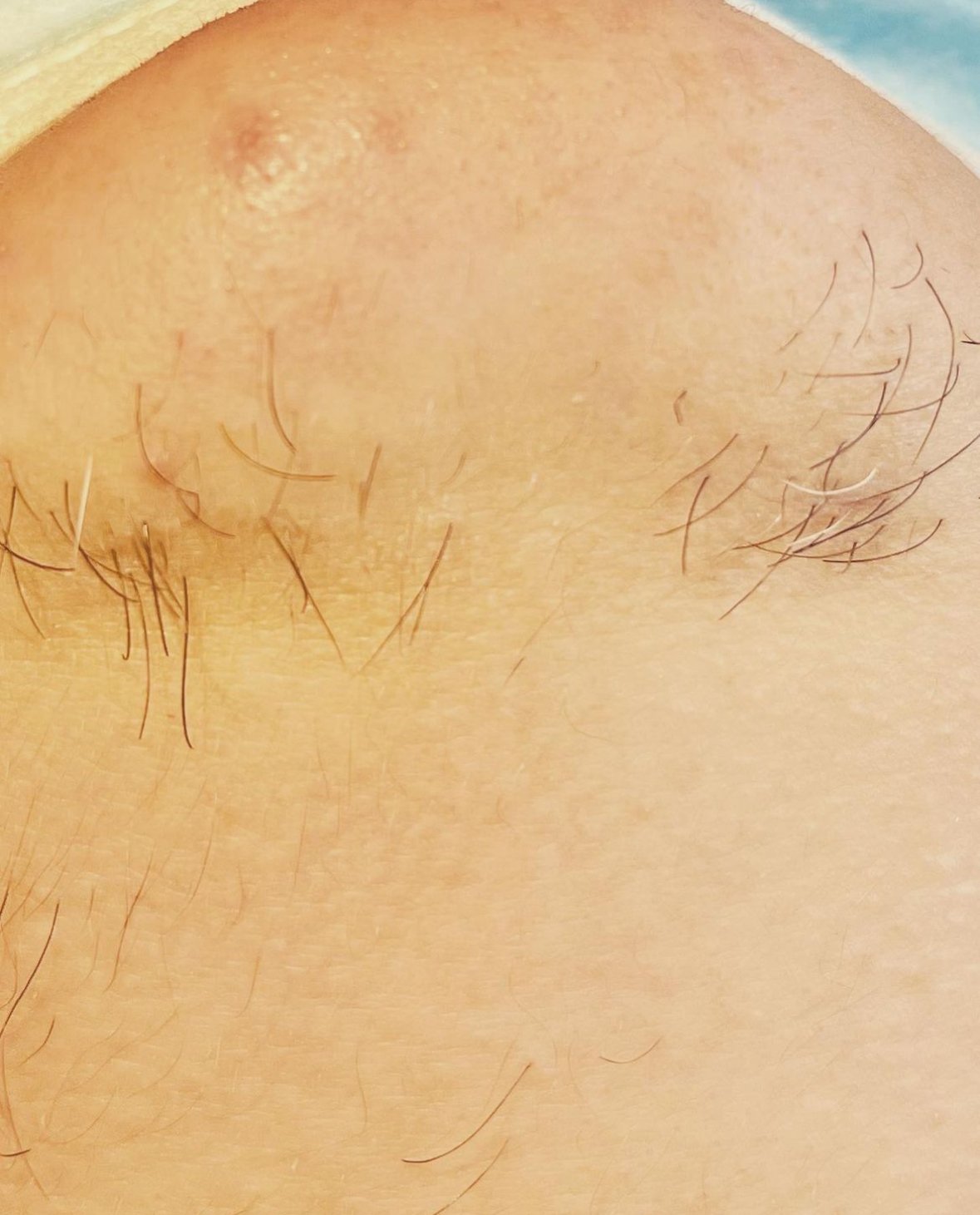 Before first treatment