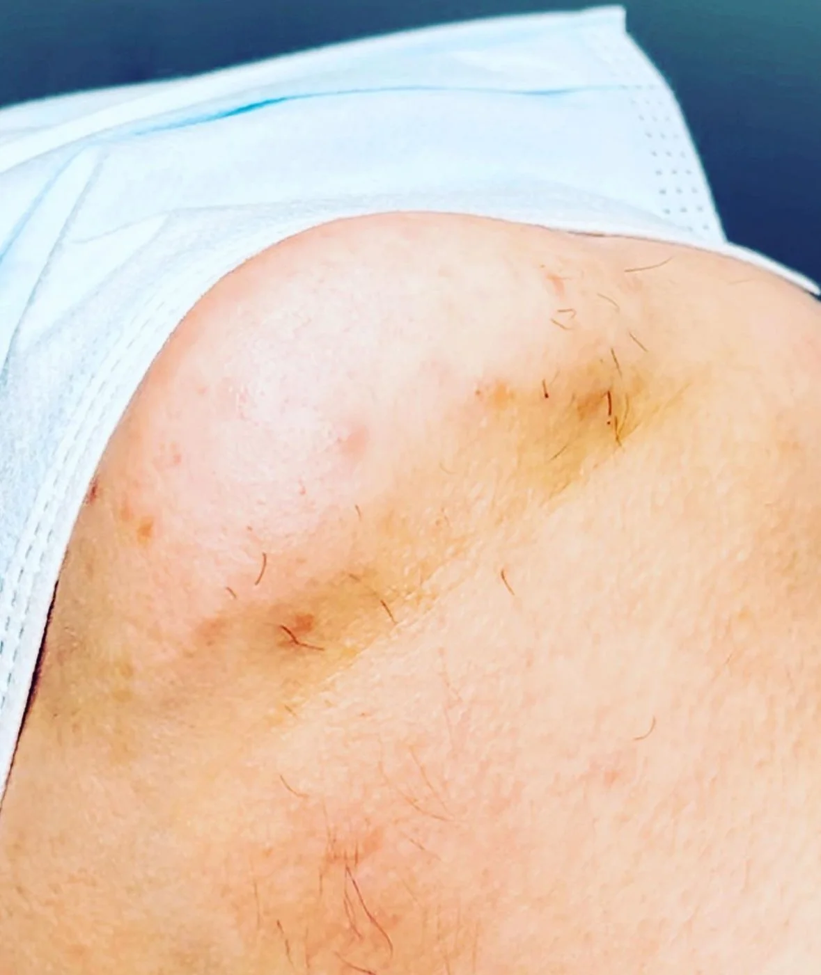 3 weeks after first treatment