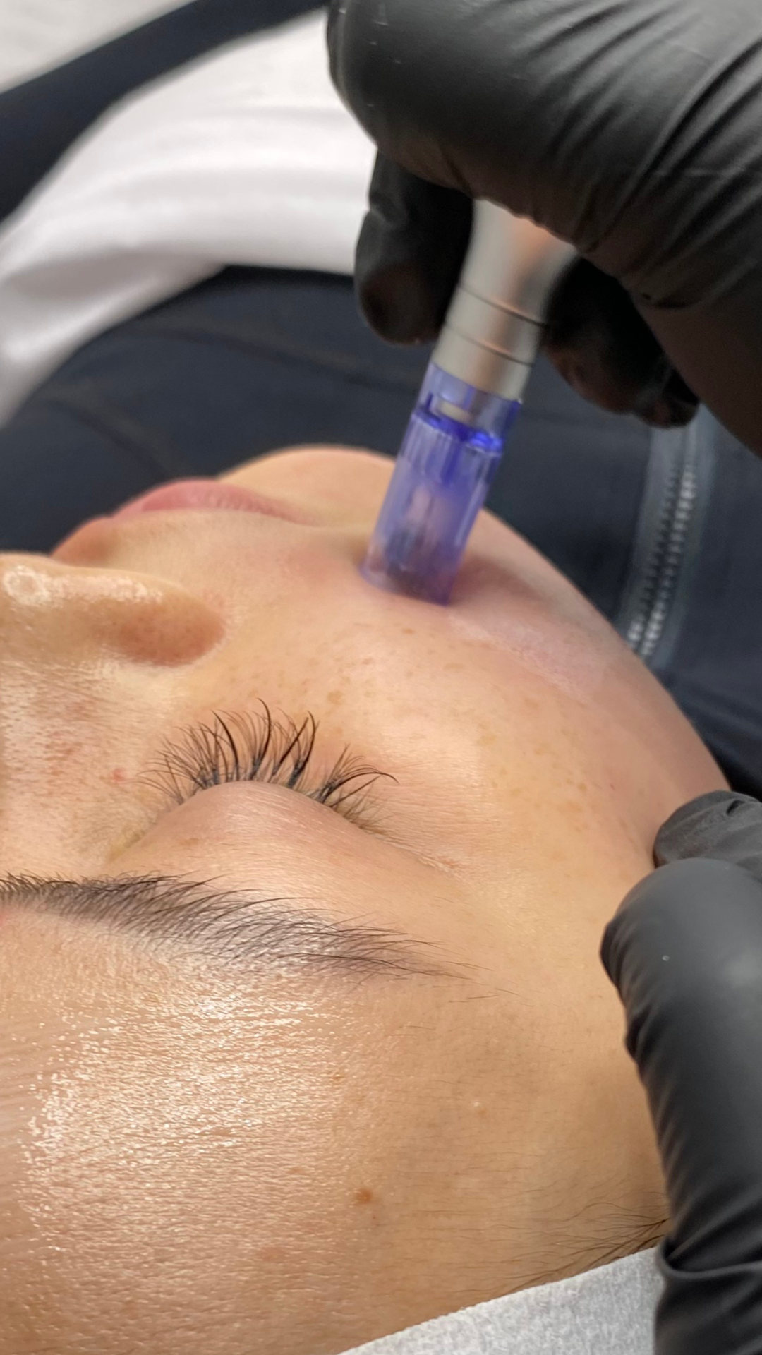 best facial prahran melbourne skin therapy dermal therapy melbourne skin needling aramadale south yarra melbourne prahran windsor collagen induction therapy is skin needling good for acne antiageing skin tightening morpheus 8 fraxis co32 laser genesi