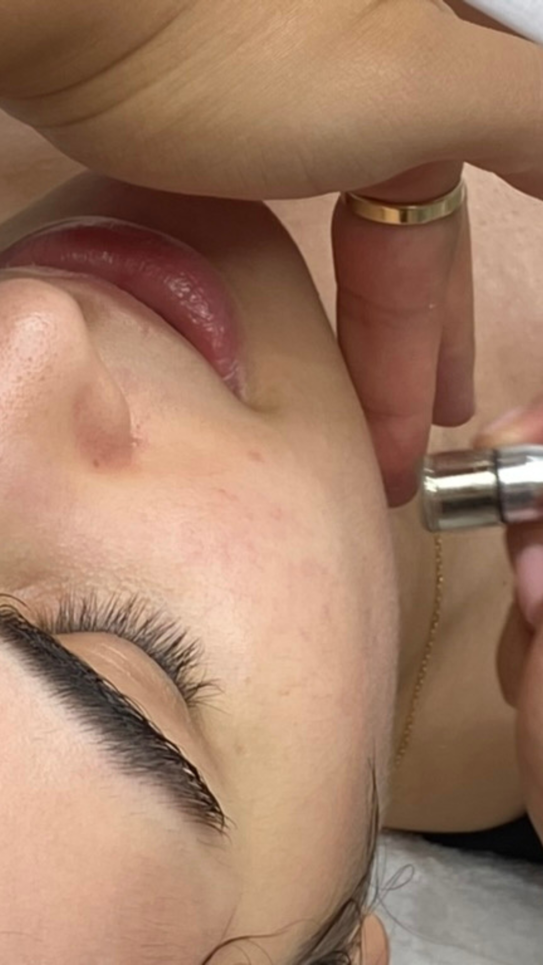 best facial prahran melbourne skin therapy dermal therapy melbourne skin needling aramadale south yarra melbourne prahran windsor collagen induction therapy is skin needling good for acne antiageing skin tightening morpheus 8 fraxis co32 laser genesi