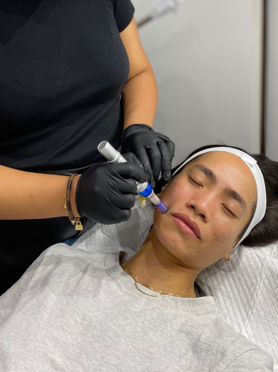 best facial prahran melbourne skin therapy dermal therapy melbourne skin needling aramadale south yarra melbourne prahran windsor collagen induction therapy is skin needling good for acne antiageing skin tightening morpheus 8 fraxis co32 laser genesi