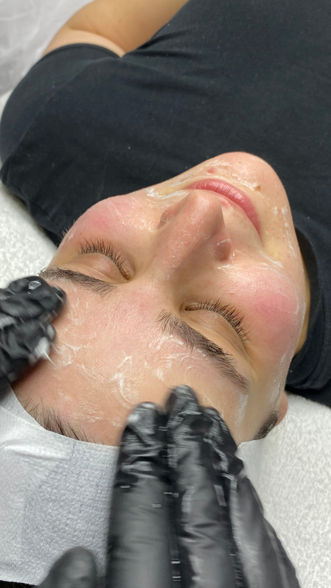 best facial prahran melbourne skin therapy dermal therapy melbourne skin needling aramadale south yarra melbourne prahran windsor collagen induction therapy is skin needling good for acne antiageing skin tightening morpheus 8 fraxis co32 laser genesi