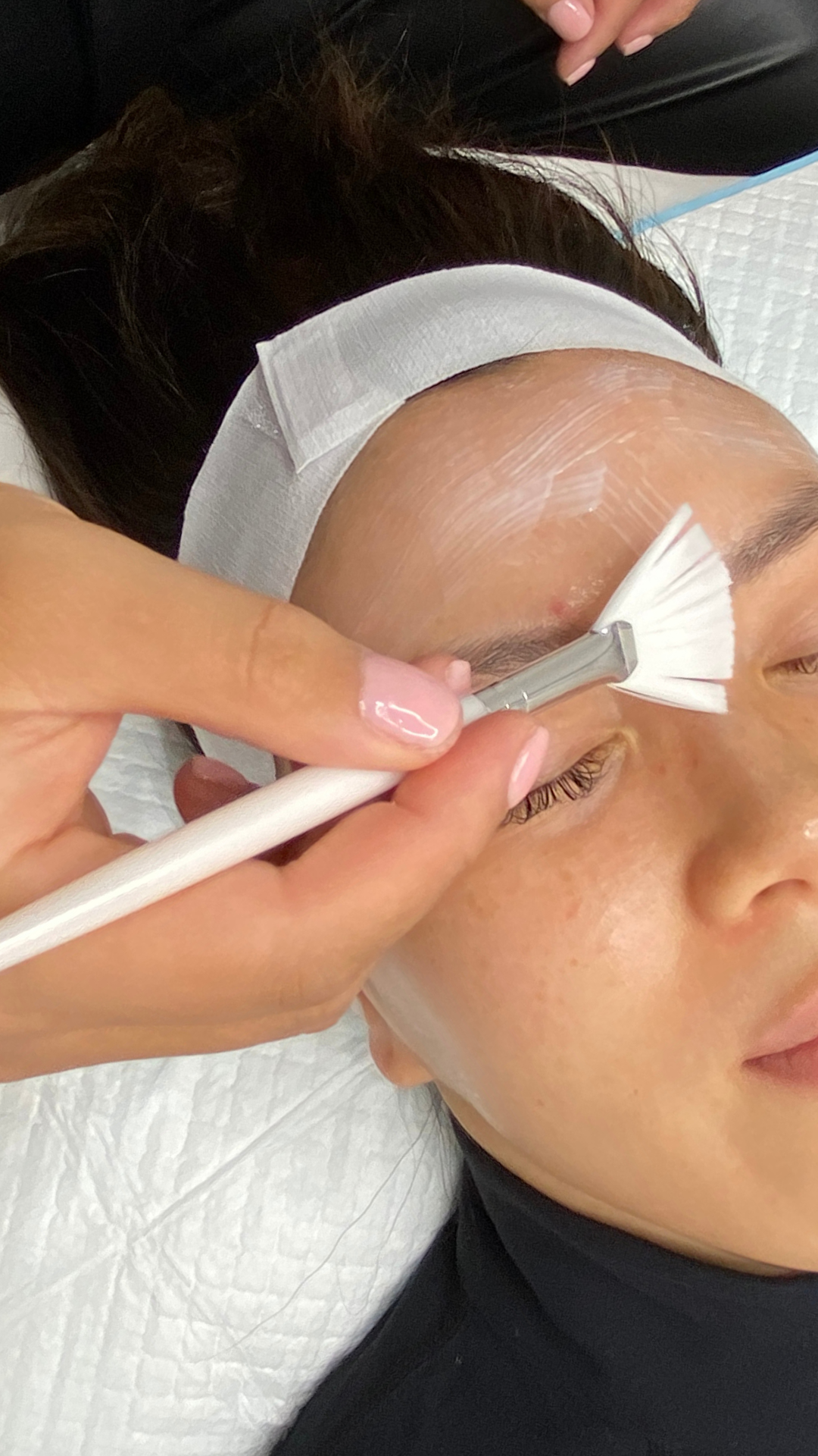 chemical peel melbourne prahran acne removal best treatments for acne