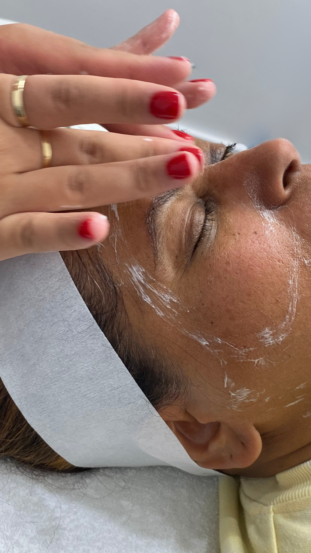 best facial prahran melbourne skin therapy dermal therapy melbourne skin needling aramadale south yarra melbourne prahran windsor collagen induction therapy is skin needling good for acne antiageing skin tightening morpheus 8 fraxis co32 laser genesi