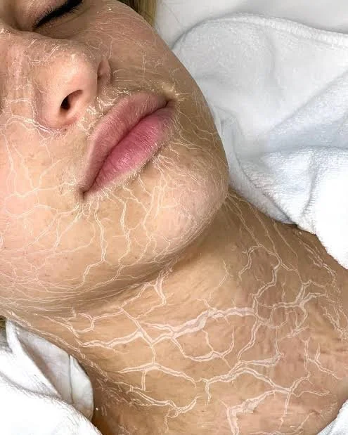 best facial prahran melbourne skin therapy dermal therapy melbourne skin needling aramadale south yarra melbourne prahran windsor collagen induction therapy is skin needling good for acne antiageing skin tightening morpheus 8 fraxis co32 laser genesi
