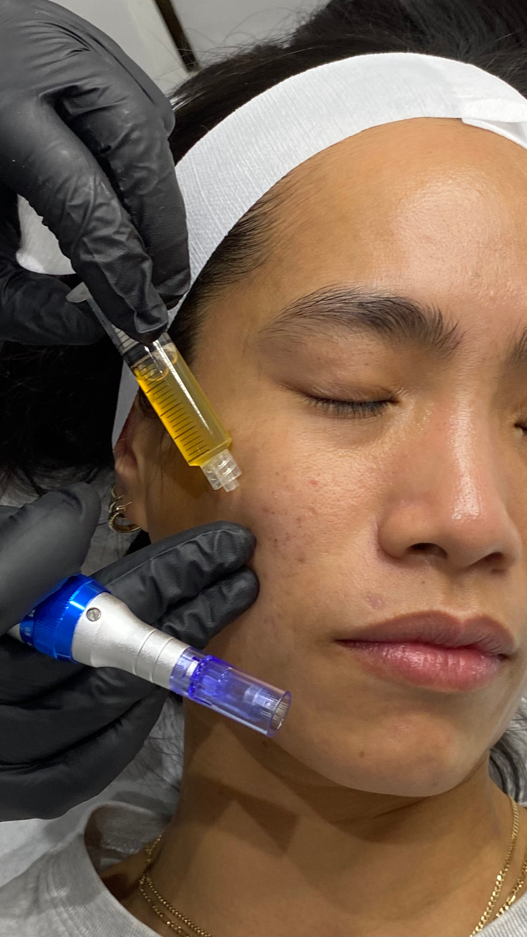 prp platelet rich plasma fibrin vampire facial acne scar reduction brightening liquid gold facial kim k vampire facial 