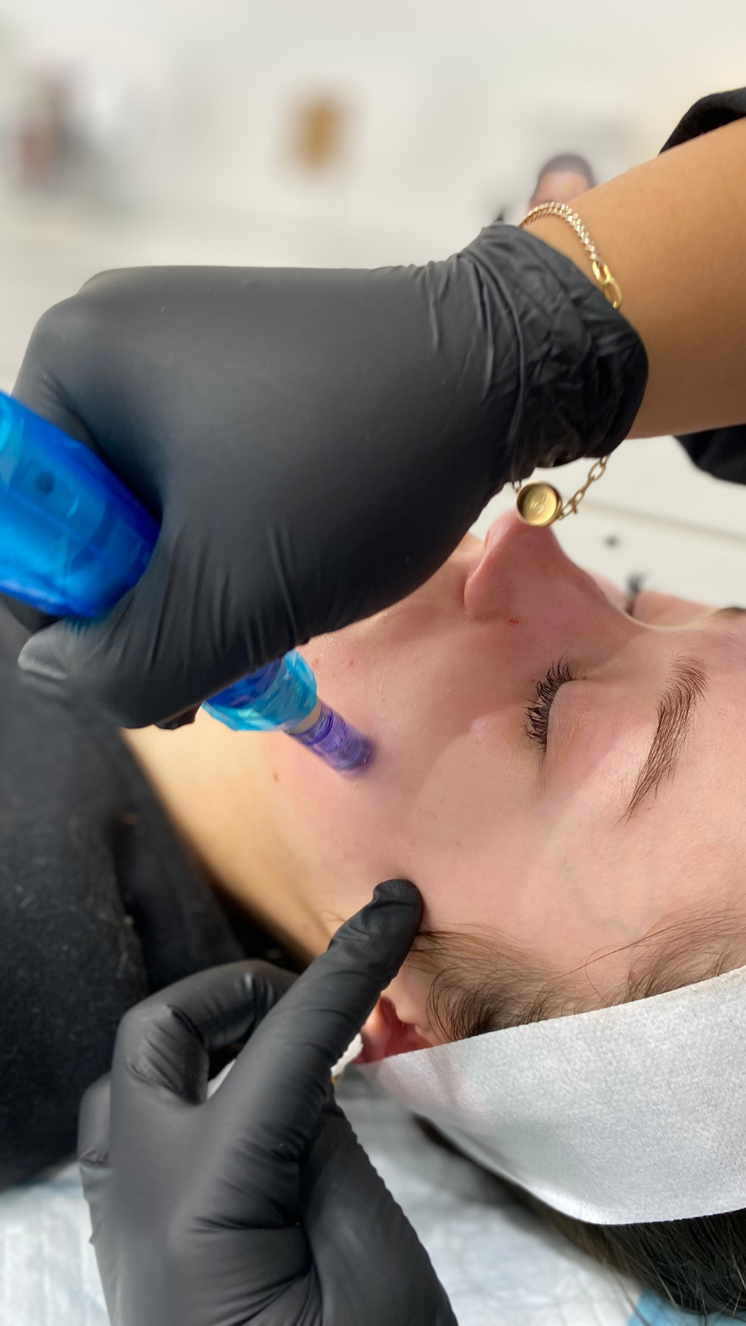 Person receiving facial treatment with blue microneedling device and black gloves