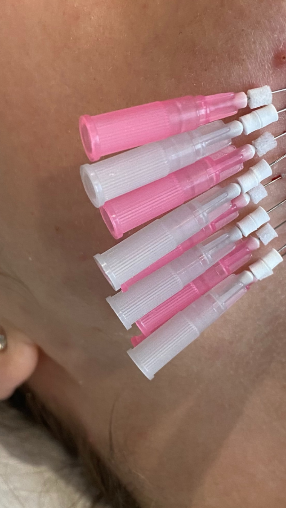 best facial prahran melbourne skin therapy dermal therapy melbourne skin needling aramadale south yarra melbourne prahran windsor collagen induction therapy is skin needling good for acne antiageing skin tightening morpheus 8 fraxis co32 laser genesi