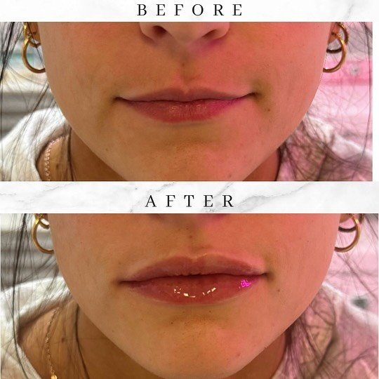 Check out these results done by our RN Erica! She achieved this fullness using #juvedermultra 💋 We also use the cannula method which is less traumatic on the lips which equals less bruising. #ctmedspa #lipfillerct