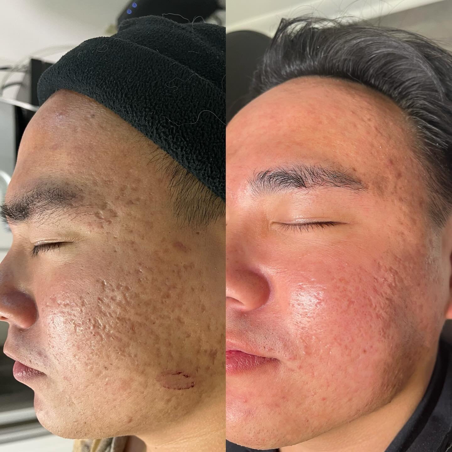 Clients often point to our RF Microneedling machine and ask &ldquo; What does this machine do?&rdquo; Well let me show you! 👉🏼 This client had 3 RF needle treatments with chemical peels in between to help his acne scarring. Micro needling causes in