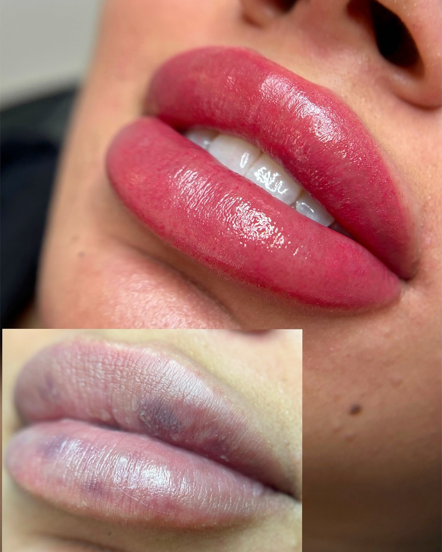 Sometimes filler just isn&rsquo;t enough. Lip pigmentation can redefine your borders and the appearance of a larger lip. 🫦 swelling is normal and will subside within 12 hours. if you&rsquo;re interested in learning more about having a brighter looki