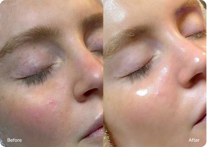 Close-up of a person's face showing a side-by-side comparison of skin before and after a skincare treatment. The left side labeled 'Before' shows skin with some redness and uneven tone, while the right side labeled 'After' shows smoother, more radiant skin with a glow.