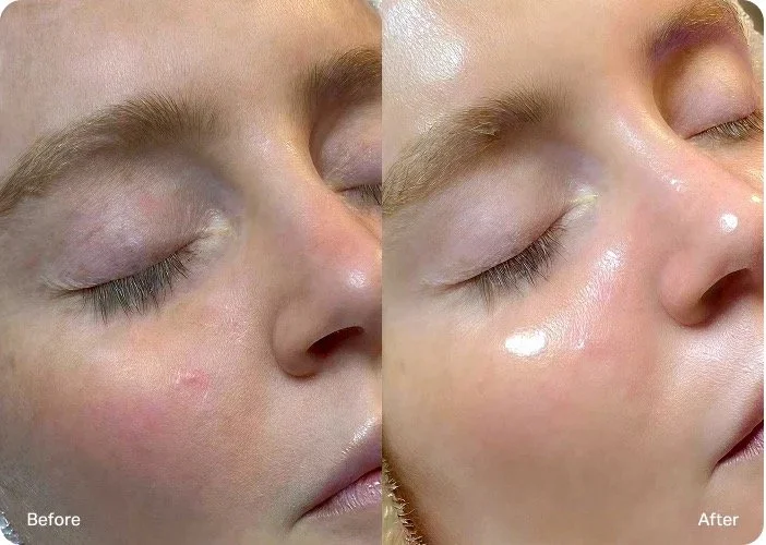 Hydrafacial Greensburg, IN