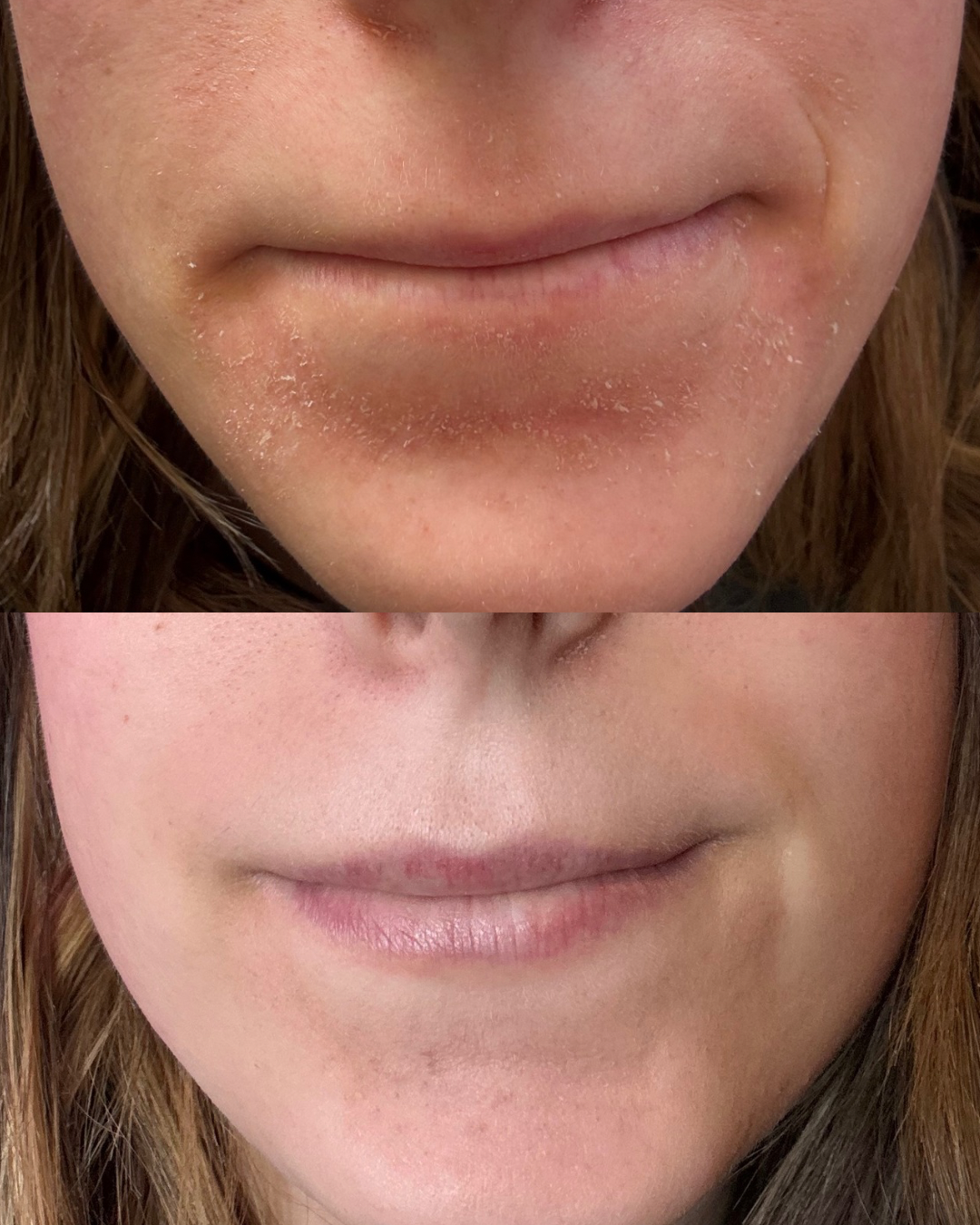 Comparison of dry lips before and after treatment