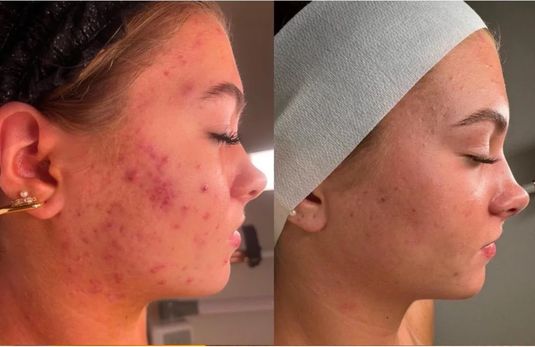 acne treatment greensburg IN