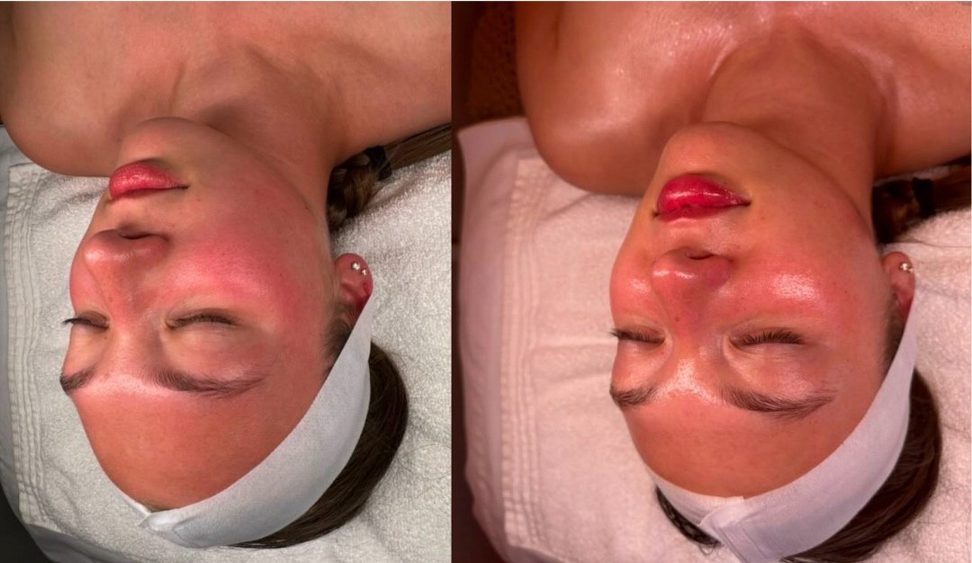 Side-by-side comparison of two women lying down with facial treatments, both wearing white headbands and showing red, glossy skin.