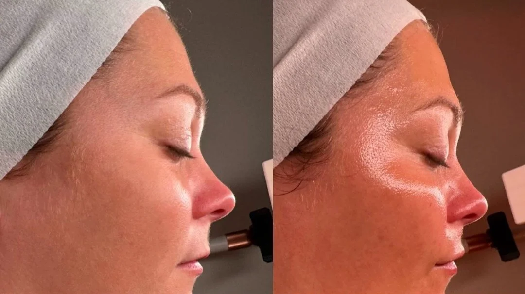 Side-by-side comparison of a woman's face before and after a skincare treatment, showing smoother and more radiant skin on the right.