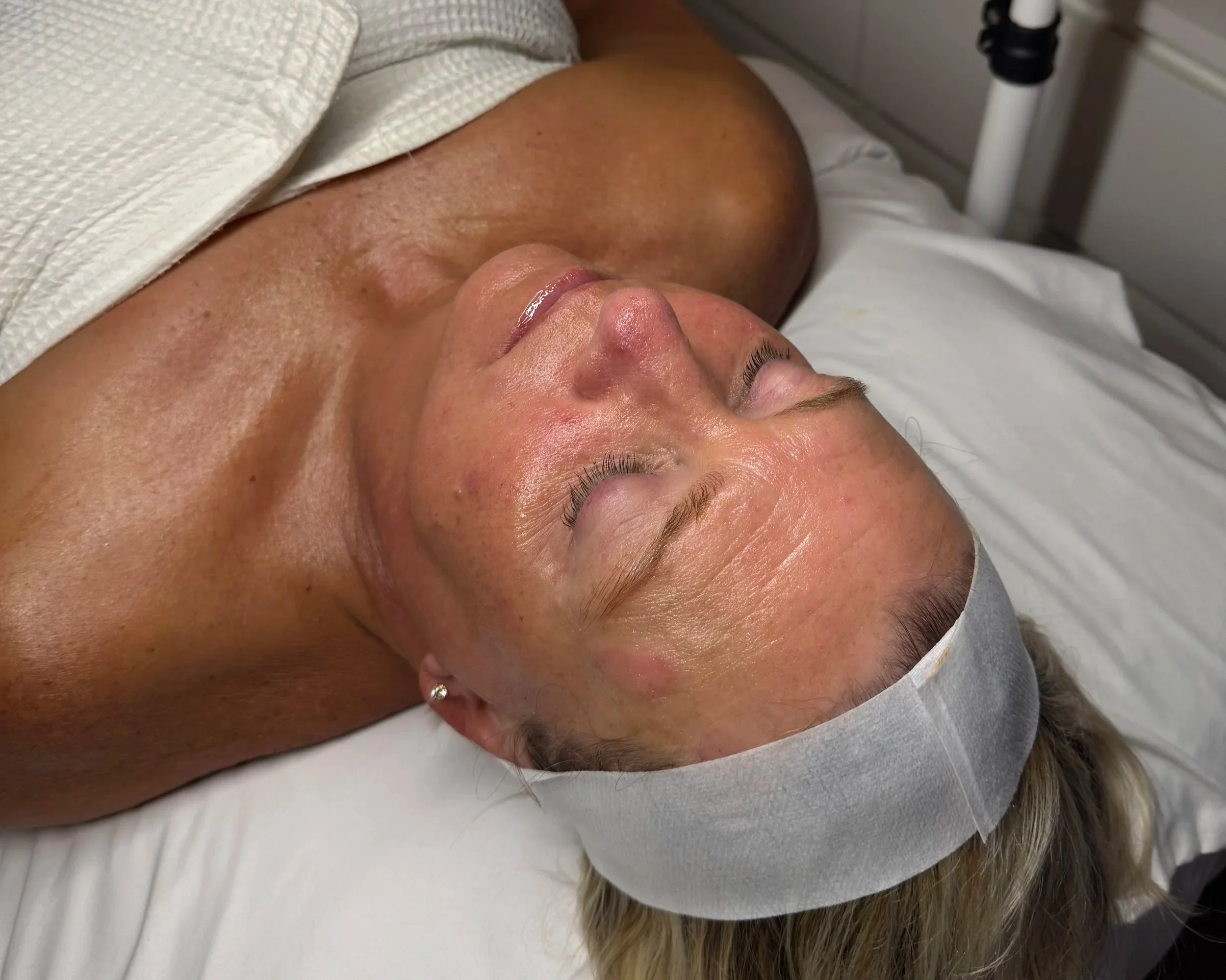 skin by kenn hydrafacial