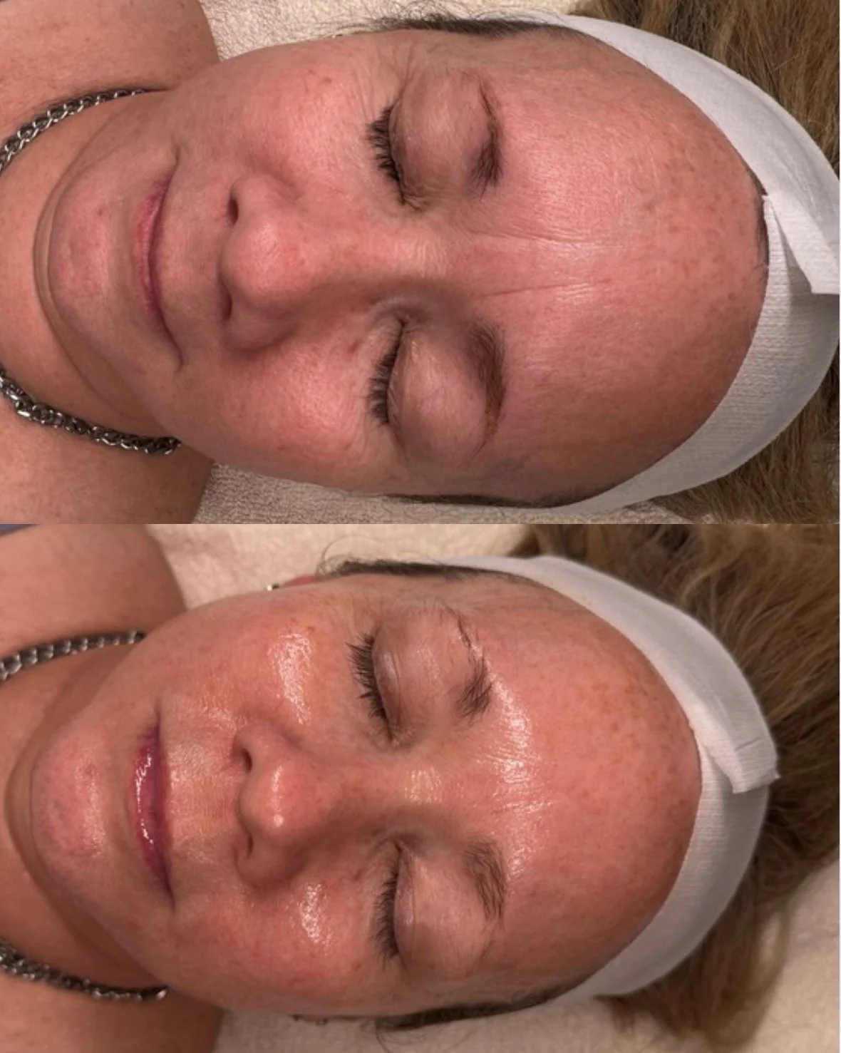 Before and after images of a woman receiving skincare treatment, showing improved skin texture and glow in the after photo.