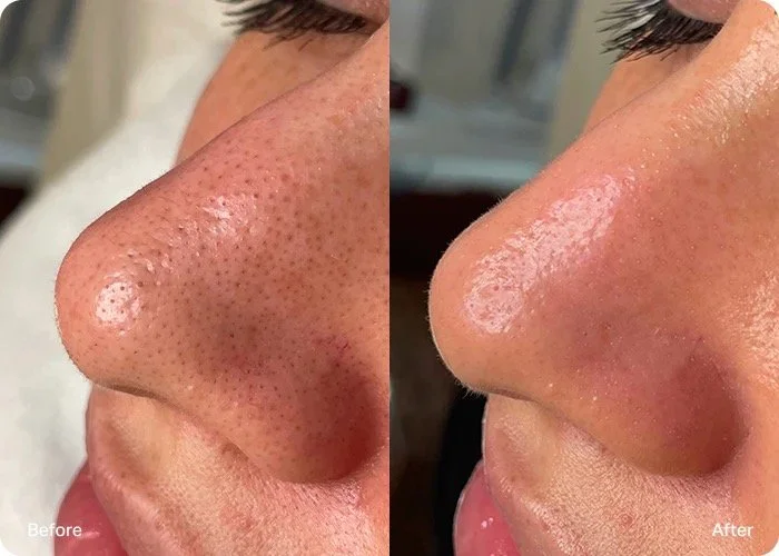 Close-up side view of a person's nose before and after skincare treatment. The before side shows large visible pores and blackheads, while the after side shows a smoother, clearer nose with reduced pore size.