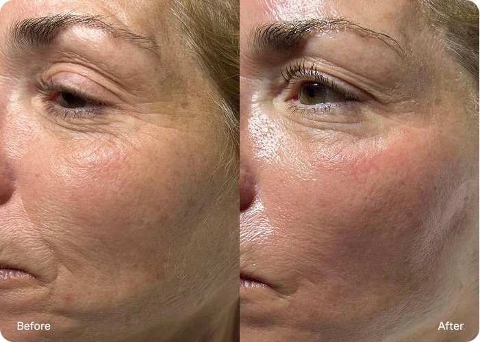 Comparison photo showing a person's face before and after skincare treatment, highlighting reduced wrinkles, smoother skin texture, and increased skin brightness.