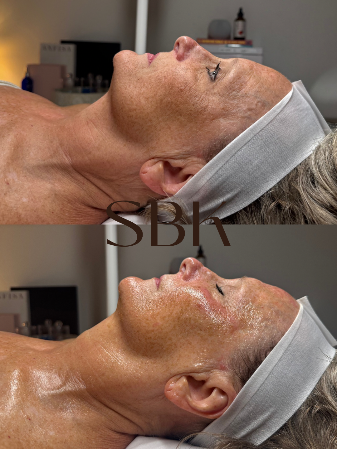 hydrafacial results
