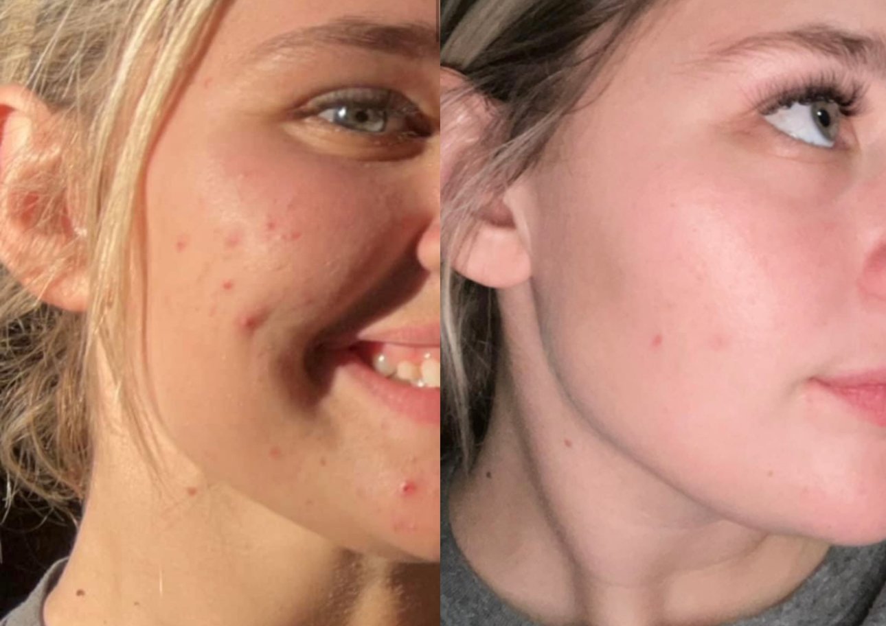 Comparison of a face with acne on the left and clearer skin on the right, showing skin improvement.