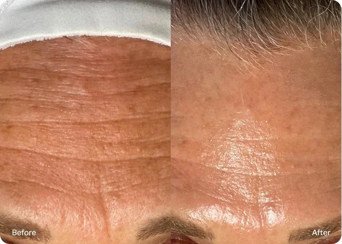 Close-up of a forehead showing a before and after comparison of skin treatment, with reduced wrinkles and smoother skin in the after image.