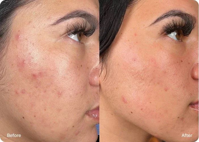 Side view of a woman's face showing before and after images of skin improvement, with reduced acne scars and smoother skin after treatment.