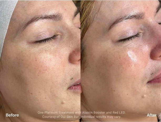Close-up of a woman's face showing before and after results of a skincare treatment, with improvements in skin texture and appearance.