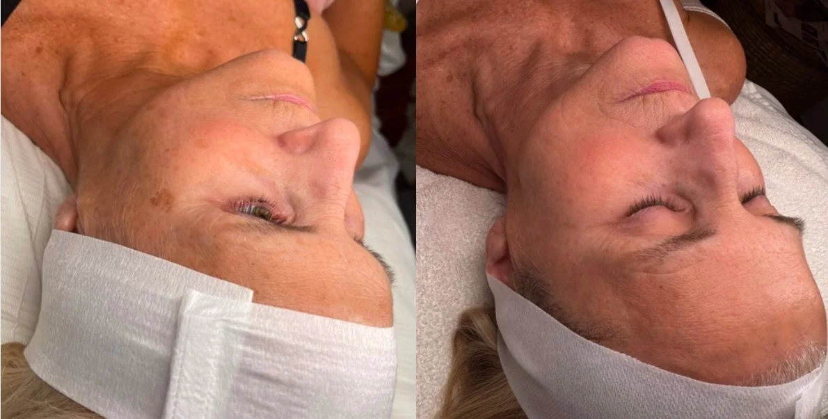 microneedling greensburg IN