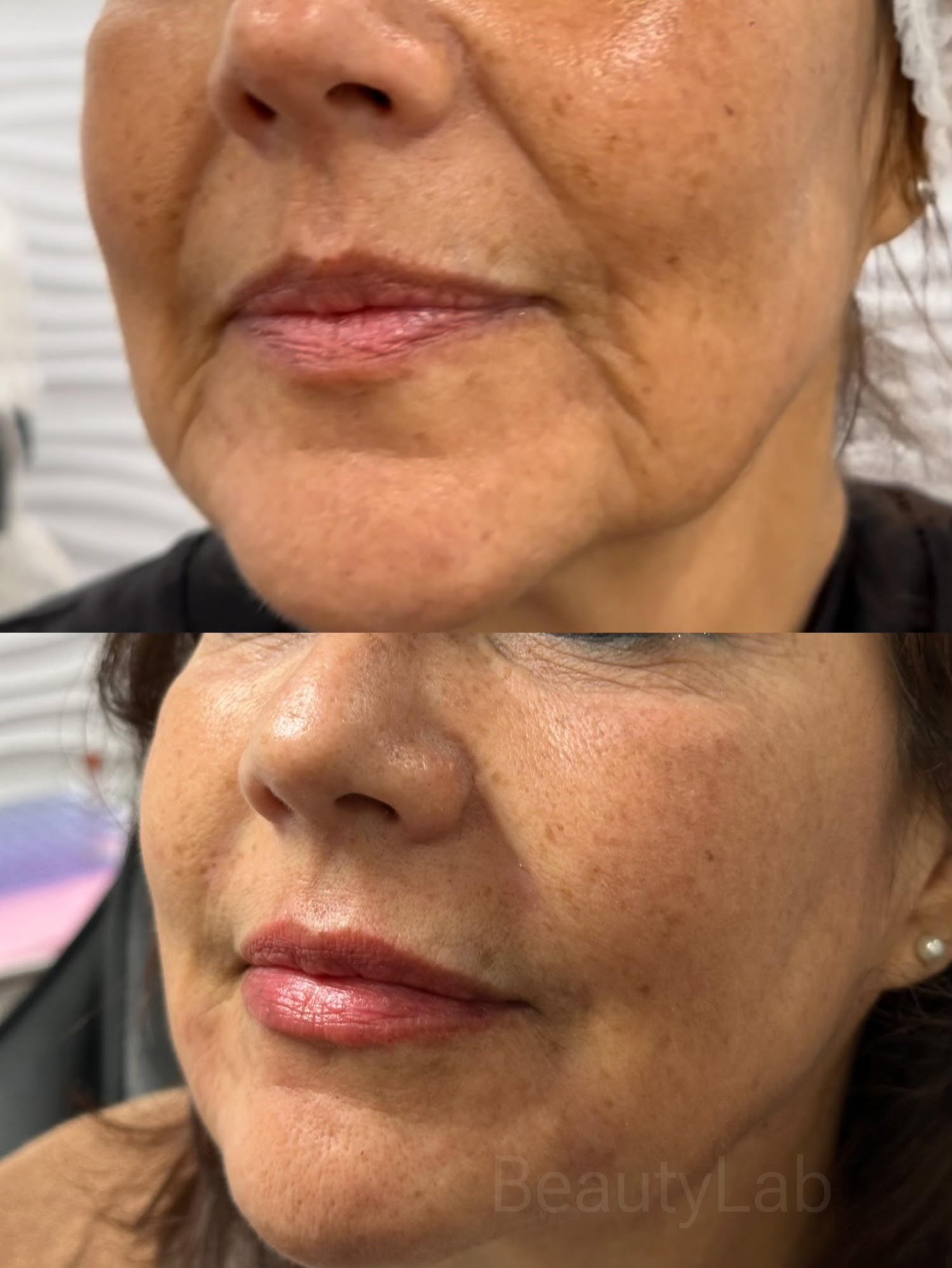 Nasolabial fold filler