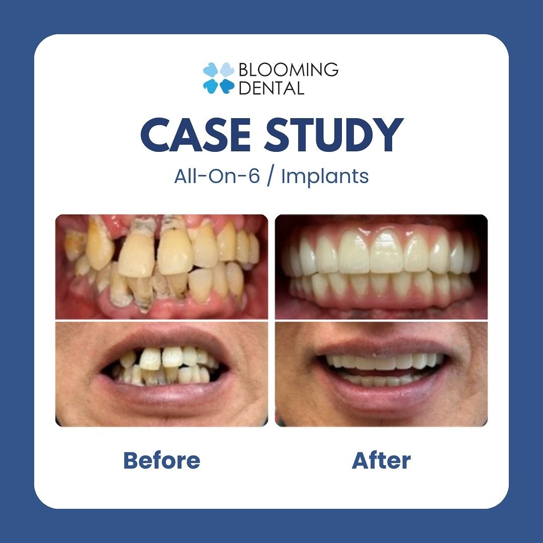 The All-on-4 and All-on-6 techniques are groundbreaking solutions for those facing extensive tooth loss or severe dental issues. They involve the strategic placement of dental implants to support a full arch of teeth, providing patients with a perman