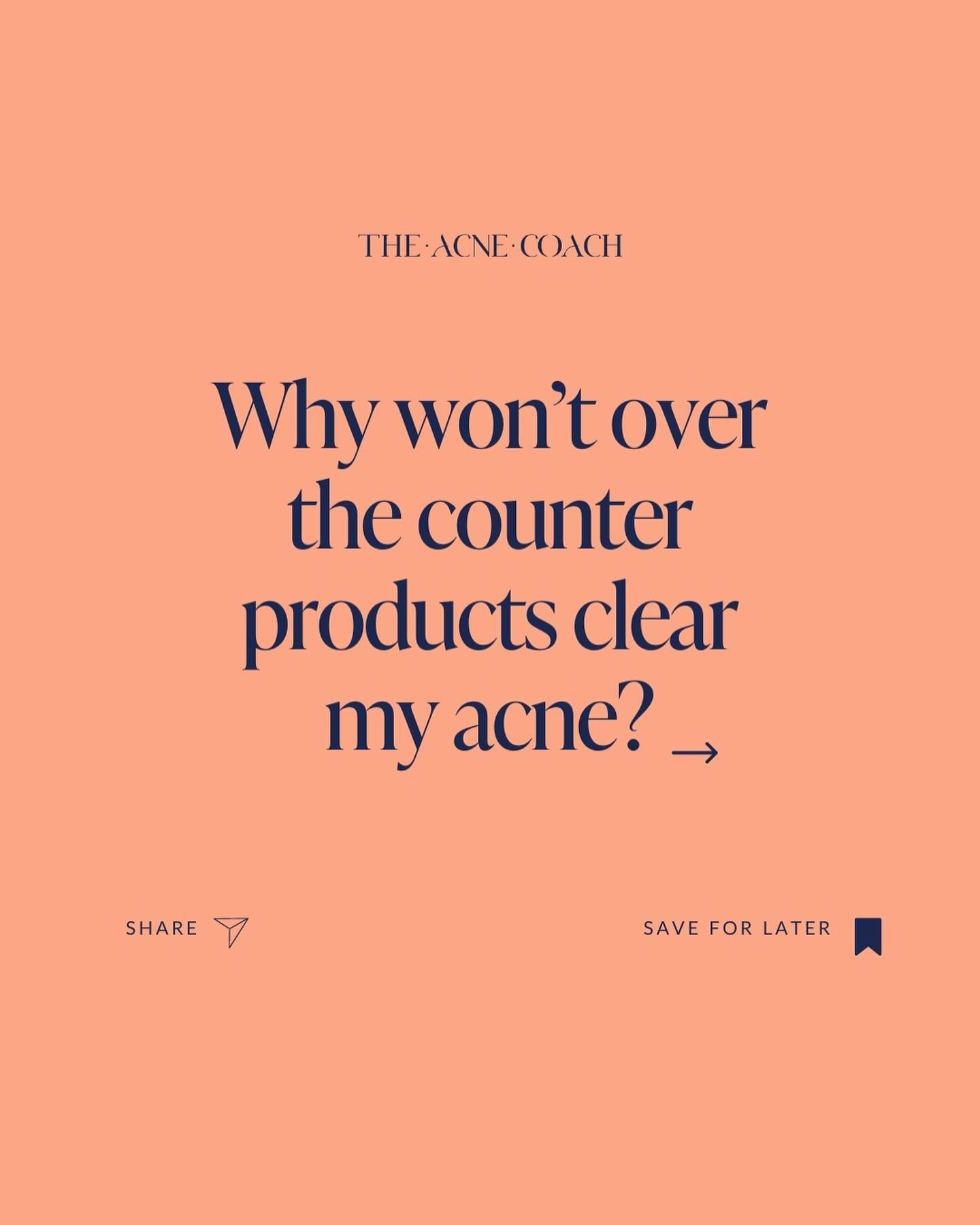 Here&rsquo;s why over the counter (OTC) products won&rsquo;t work for acne 👇

#1 95% of skincare products contain pore clogging ingredients, which is the number one contributor to acne. It&rsquo;s almost impossible to find any product that doesn&rsq